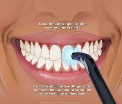You will also get the solutions of your answers. Dental Bonding Nashville Tn Gulch Dental Studio