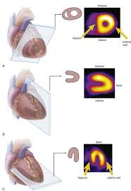 Image result for Nuclear Ventriculogram