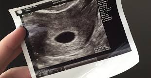 Abortus) adalah berakhirnya kehamilan dengan dikeluarkannya janin (fetus) atau embrio sebelum memiliki kemampuan untuk bertahan hidup di luar rahim, sehingga mengakibatkan kematiannya. Apa Itu Kehamilan Kosong Ketahui Punca Tanda Tanda Dan Rawatannya Bumbumcak My