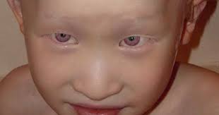 Violet Eyes Of An Albino Child Beautiful Vitiligo Cure Vitiligo Treatment What Is Vitiligo