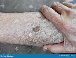 Image result for liver spots on legs