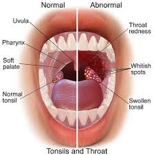 7 Home Remedies To Get Rid Of Tonsillitis Or Swollen Tonsils Throat Infection Remedies For Swollen Tonsils Swollen Tonsils