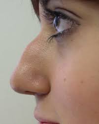 How do you know if you broke your nose. Is Rhinoplasty Worth It My Nose Job Experience Bellatory