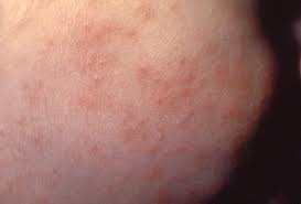 May 30, 2018 · the symptoms of viral and bacterial meningitis can be similar in the beginning. Meningitis Rash Pictures Symptoms And Similar Rashes