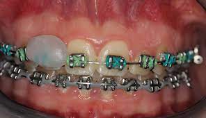The wax acts as a guard to the affected area and will help stop and contact between the braces and gums. What Is Orthodontic Wax News Dentagama