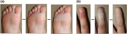 Location of pain can be a guide to the proper diagnosis. Efficacy Of A Bleomycin Microneedle Patch For The Treatment Of Warts Springerlink