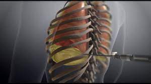 Thoracentesis - Youtube