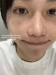 Felix Tiene Pecas