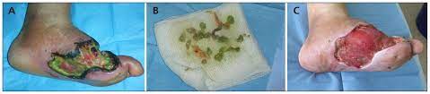 Pseudomonas Infection In A Postoperative Foot Wound Cmaj