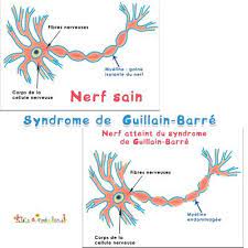 Although the classic description of gbs is that of a demyelinating neuropathy with ascending. Qu Est Ce Que Le Syndrome De Guillain Barre