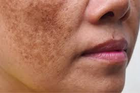 Image result for Melasma calycinum