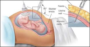 Everyone's got their normal, and that can increase in pregnancy when you're pregnant, a thick plug of mucus blocks the cervix to stop bacteria from getting into the uterus. Leaking Amniotic Fluid Signs Causes And Treatment
