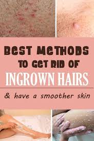 We also describe a range of ways to prevent the hairs from growing inward, including dry brushing, using shaving cream. How To Get Rid Of Ingrown Hair Ingrown Hair Remedies Ingrown Hair Treat Ingrown Hair