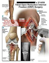 The Nitty Gritty Of The Surgery Tibial Plateau Fracture Knee Surgery Knee Injury