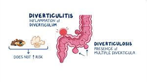 Image result for Diverticulitis