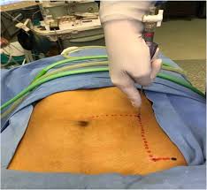 We take you step by step through this technique to help avoid bowel injury. A Retrospective Study Of A Novel Non Umbilical Laparoscopic Entry Port In Thin Patients Jain Point Gynecological Surgery Full Text