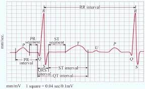Image result for Pulseless Electrical Activity