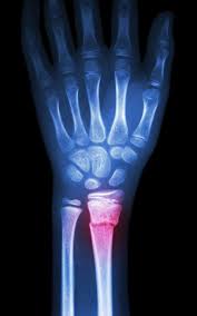 Image result for Fracture