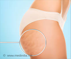 The simplest way is dry brushing which stimulates the lymphatic and blood flow in the body and removes the rise in the toxins which made up the cellulite. Cellulite Treatment Causes Risk Factors Treatment Alternative Medicines