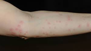 Sepsis is a syndromic response to infection and is frequently a final common pathway to death from many infectious diseases worldwide. Frostbeulen An Den Zehen Neue Symptome Fur Eine Corona Infektion Das Erste