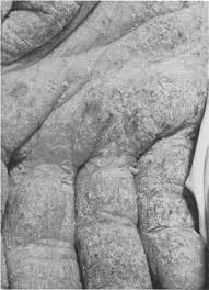 Image result for scabies norvegica