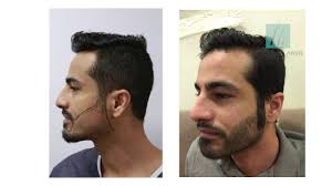 مريضنا من السعودية في تجربة عملية زراعة اللحية عند عيادة الدكتور سركان ايجن كافة الخطوات Youtube