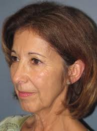 Chin Augmentation Before and After Photos by Larry Nichter, MD; Newport  Beach, CA