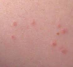 Home Remedies For Bed Bug Bitesgrandma S Home Remedies Bed Bug Bites Bug Bites Remedies Bed Bug Bites Pictures