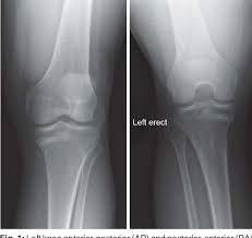Image result for Tibia Stress Fracture