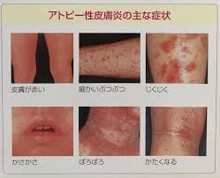 アトピーq a 診断 q5 どんな症状がアトピー a5 おでこ 目の周り 口の周り 首 手足関節 胸や背中などに 赤くなる ぶつぶつ じくじく ぽろぽろ かたくなる 症状があり 強いかゆみを伴います 長期間 乳児2ヶ月 その他6ヶ月以上 続く場合にアトピーと