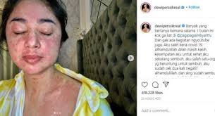 Ruam Kulit Dewi Persik Saat Covid 19 Akibat Varian Baru Virus Corona