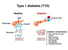 Difference Between Type 1 And Type 2 Diabetes Mellitus
