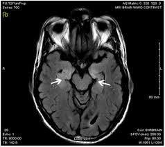 Herpes simplex encephalitis (hse) is an acute or subacute illness that causes both general and focal signs of li jz, sax pe. 18 Year Old Female With A Change In Mental Status The Western Journal Of Emergency Medicine