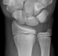 Experts say that if you have been experiencing pain, swelling, or tenderness in your legs or feet, you could be people who increase their physical activity after being sedentary for a long time have a higher likelihood of developing stress fractures.9 x trustworthy. Fracture Education Mcq