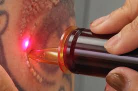 Laser tattoo removal services in london, ontario laser technology is the safest and most effective treatment for tattoo removal. Laser Tattoo Removal In London How It Works London Laser Clinics