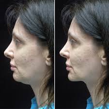 Chin Implant