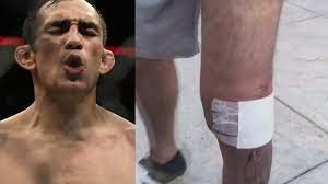 Tony ferguson is the kind of guy that gives the spotlight to the camera guy. Tony Ferguson S Knee Is Healing Up Just Had Knee Surgery This Month Twt Youtube