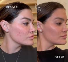 The Power of CO2 ✨ Brighter skin ✔️ Pigmentation ✔️ Even skin tone ✔️  Under-eye wrinkles/bags ✔️ Skin elasticity ✔️ 💫 Reveal smoother, tighter,  more radiant skin with our advanced CO2 laser.