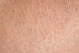 Image result for Ichthyosis