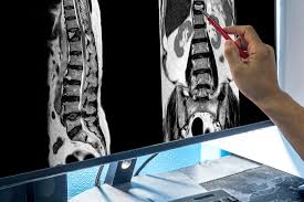 Image result for Spinal Trauma