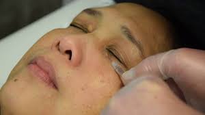 Image result for xantelasma