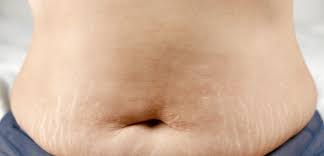 How to Treat and Calm Itchy Stretch Marks - DOCTOR BUTLER'S