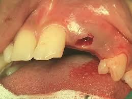 Image result for Tooth Avulsion