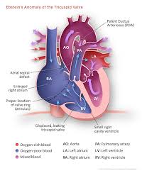 About Ebstein S Anomaly Of The Tricuspid Valve Tricuspid Valve Ebstein S Anomaly Congenital Heart Defect
