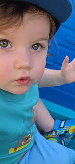 Central Heterochromia in Children's Eyes