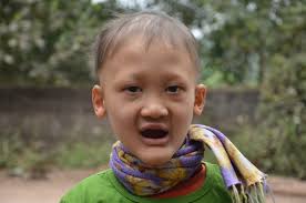 Rớt nước mắt cảnh cậu bé mồ côi mắc "bệnh lạ", 7 tuổi vẫn không mọc răng