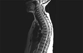 Transverse myelitis postsurgical spine avm brachial plexus post radiation therapy, eval for mass lesions, entrapment, denervation cervical spine w and w/o contrast 72156 thoracic disc disease pain radiculopathy trauma thoracic spine w/o contrast 72146 tumor infection ms syrinx transverse myelitis postsurgical spine avm Case Report Longitudinally Extensive Transverse Myelitis Practical Neurology
