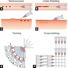 روش تزریق فیلر درمی | تزریق ژل و فیلر | رفع چین و چروک | گودبرگ