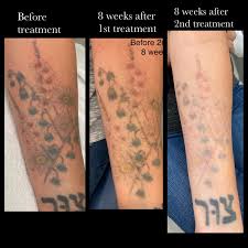 Laser tattoo removal is not recommended for you if you are breastfeeding or pregnant, or allergic to heat or cold. Progress After 2 Treatments Each Treatment Is 8 Weeks In Between I Get My Treatments At A Kaiser Cosmetic Office Tattooremoval