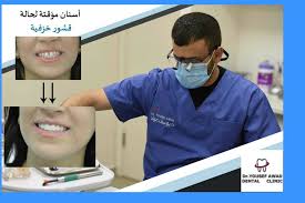 القشور الخزفية: 📋عيادة الدكتور يوسف عواد :-طمرة Dr-Yousef-Awad-Dental-Clinic  للتواصل معنا :⬅️9100645-077